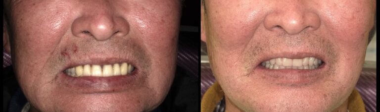 当院での入れ歯の症例